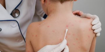 Autoridades sanitarias de Arizona y Utah monitorean el avance del mayor brote de sarampión en más de 30 años