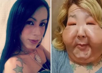 Influencer brasileña inicia tratamiento de recuperación tras procedimiento estético clandestino