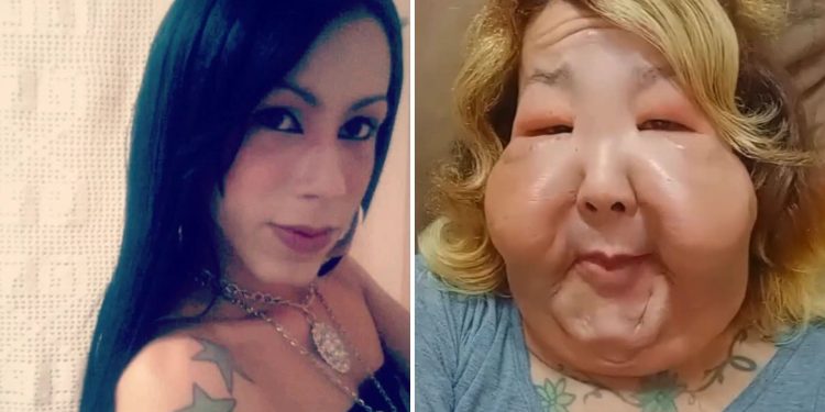 Influencer brasileña inicia tratamiento de recuperación tras procedimiento estético clandestino