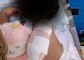 Hospital de Engombe guarda silencio ante caso de niña que perdió un brazo