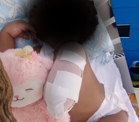 Hospital de Engombe guarda silencio ante caso de niña que perdió un brazo