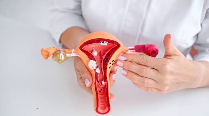 Impacto social: La Endometriosis afecta a millones de mujeres y muchas personas conocen a alguien que la padece