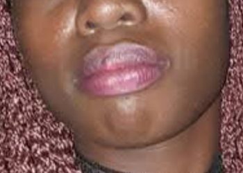 Haitiana quema las manos de su hijo menor de edad por mil pesos