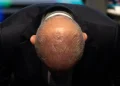 Lula inicia un tratamiento de radioterapia en el cuero cabelludo